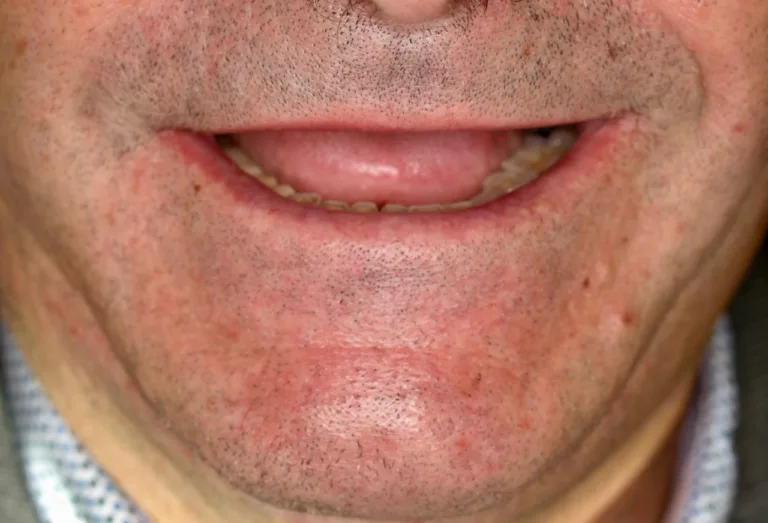 Foto de la boca de una persona sin dientes solo en la parte inferior.