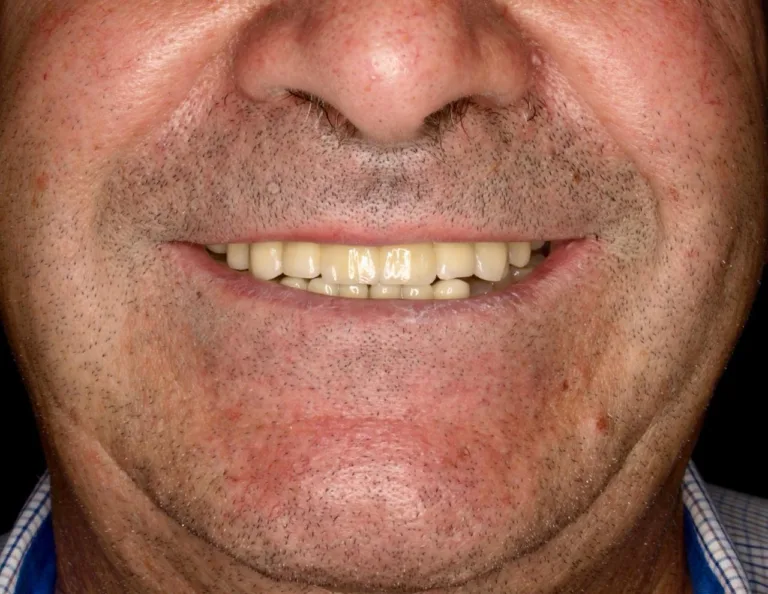Resultado de como ha quedado la dentadura